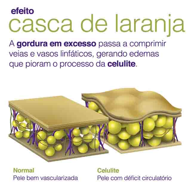 Celulite-efeito-casca-de-laranja